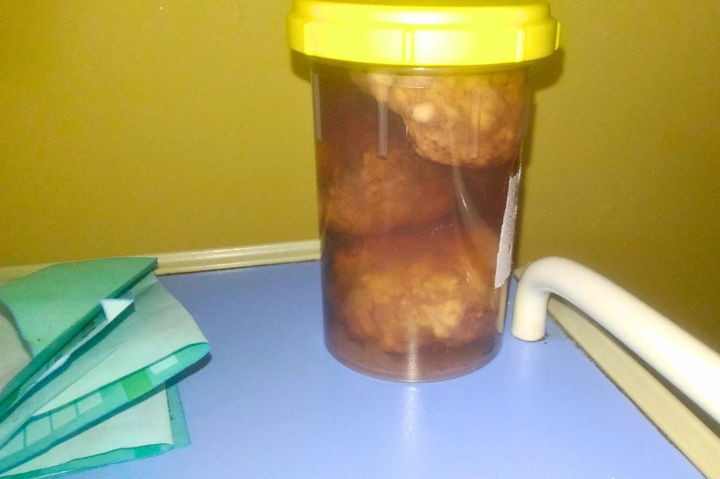 Caillots extraits lors d’une opération de la prostate
