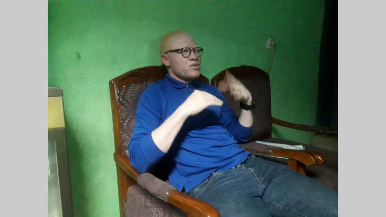 Santé : La difficile intégration sociale des albinos