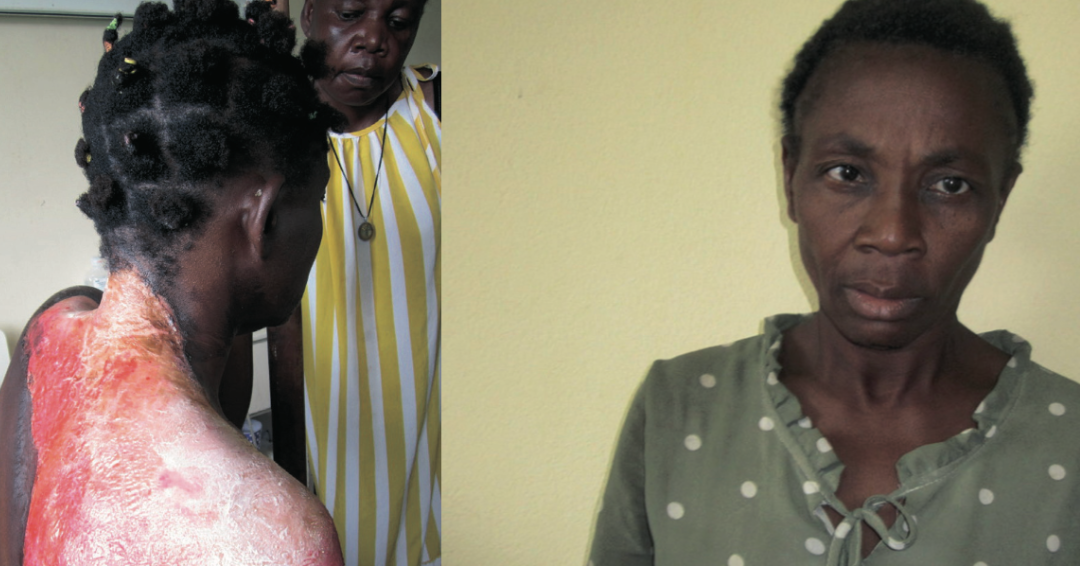 L’état de Raïssa Nfono Ndong après avoir été ébouillantée par sa belle-sœur Sophie Oyane