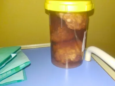 Caillots extraits lors d’une opération de la prostate