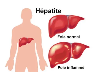 Hépatite