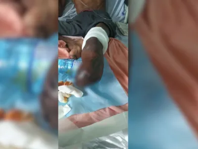 Armel Nkombe est, depuis l’année dernière, condamné à vivre avec une jambe en moins. © DR