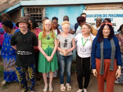 Albinisme : Faire entendre la voix des albinos à Franceville
