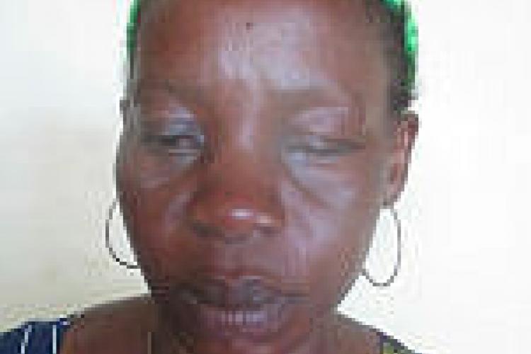 Oyem : une femme perd un œil dans une dispute conjugale