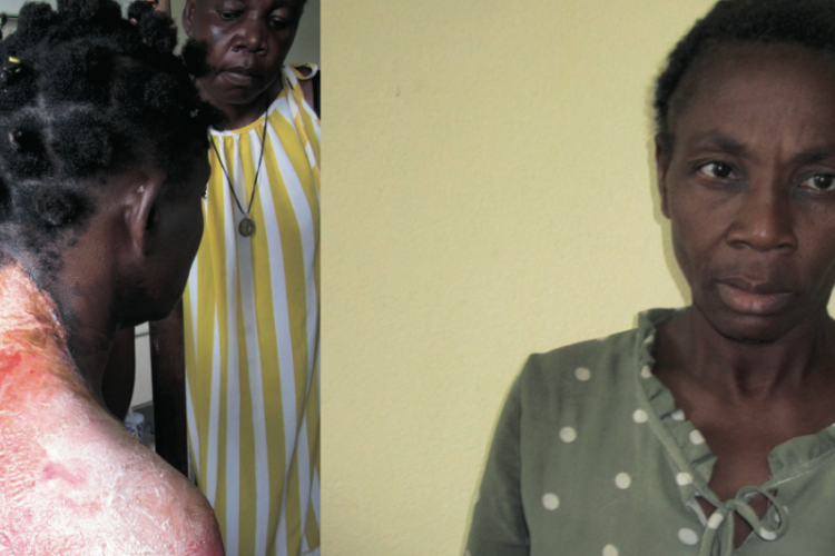 L’état de Raïssa Nfono Ndong après avoir été ébouillantée par sa belle-sœur Sophie Oyane